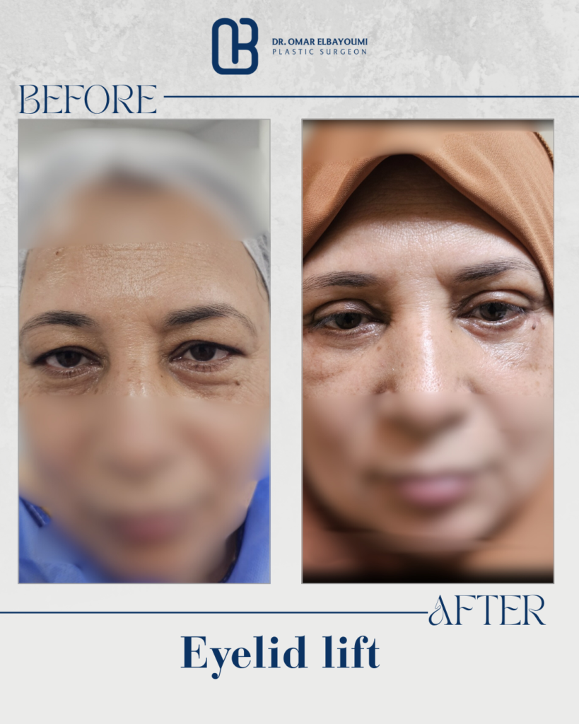 Eyelid lift._20250520_103558_٠٠٠٠
