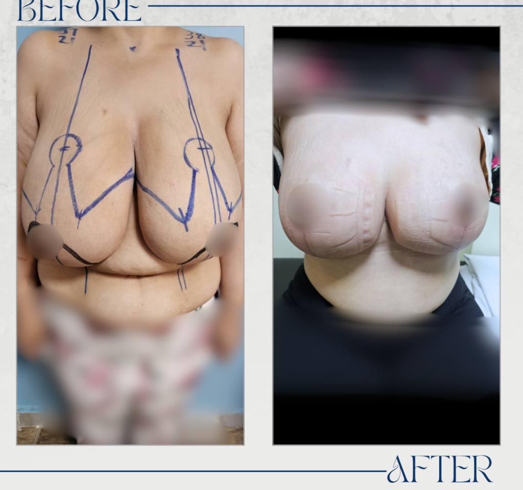 تجميل الثدي