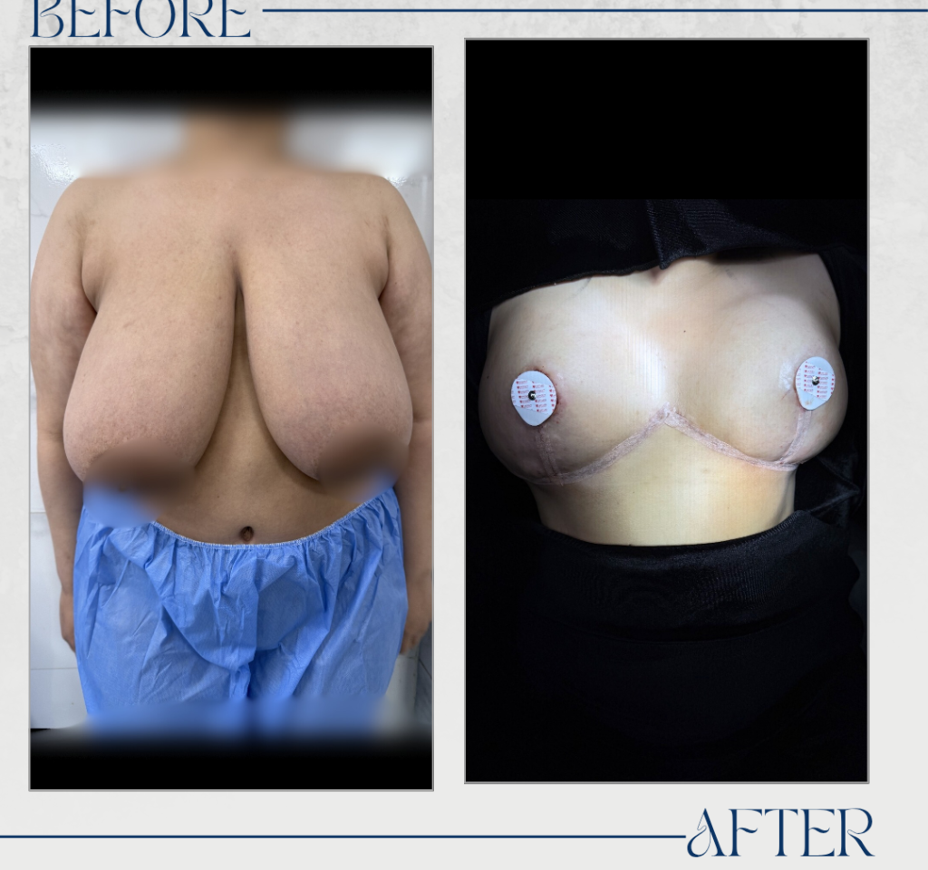 تجميل الثدي