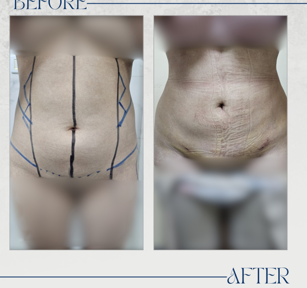 Liposuction_20250520_171512_٠٠٠٠
