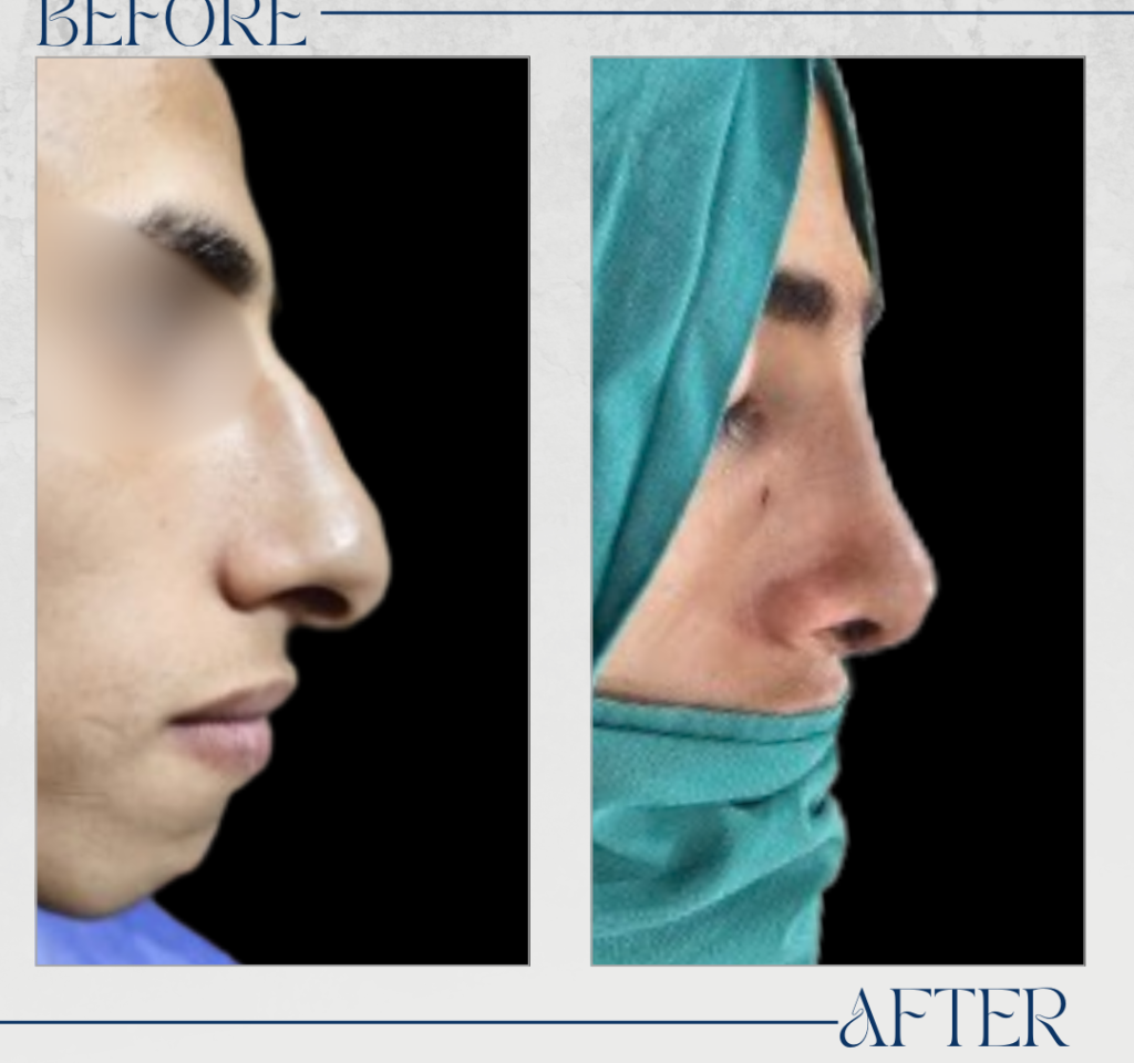 تجميل الأنف