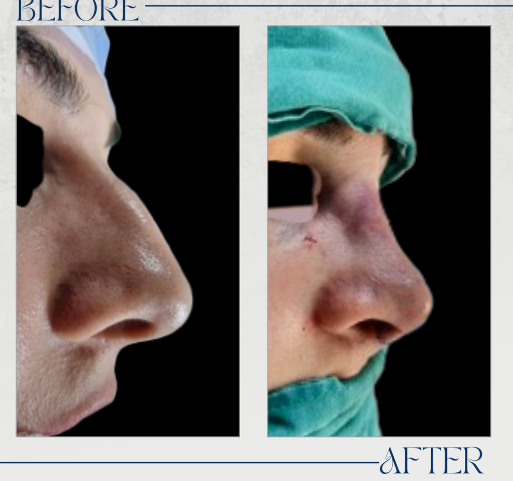 Rhinoplasty 14_20250511_133001_٠٠٠٠
