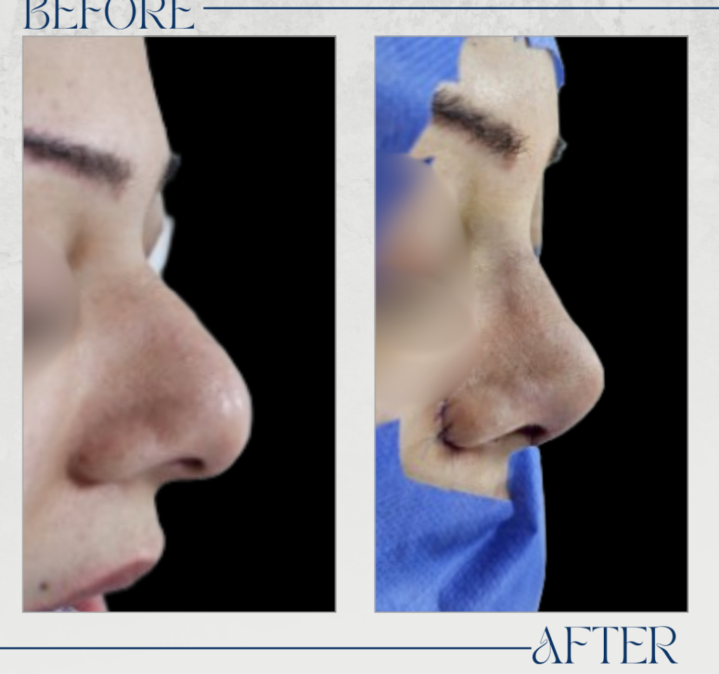 تجميل الأنف