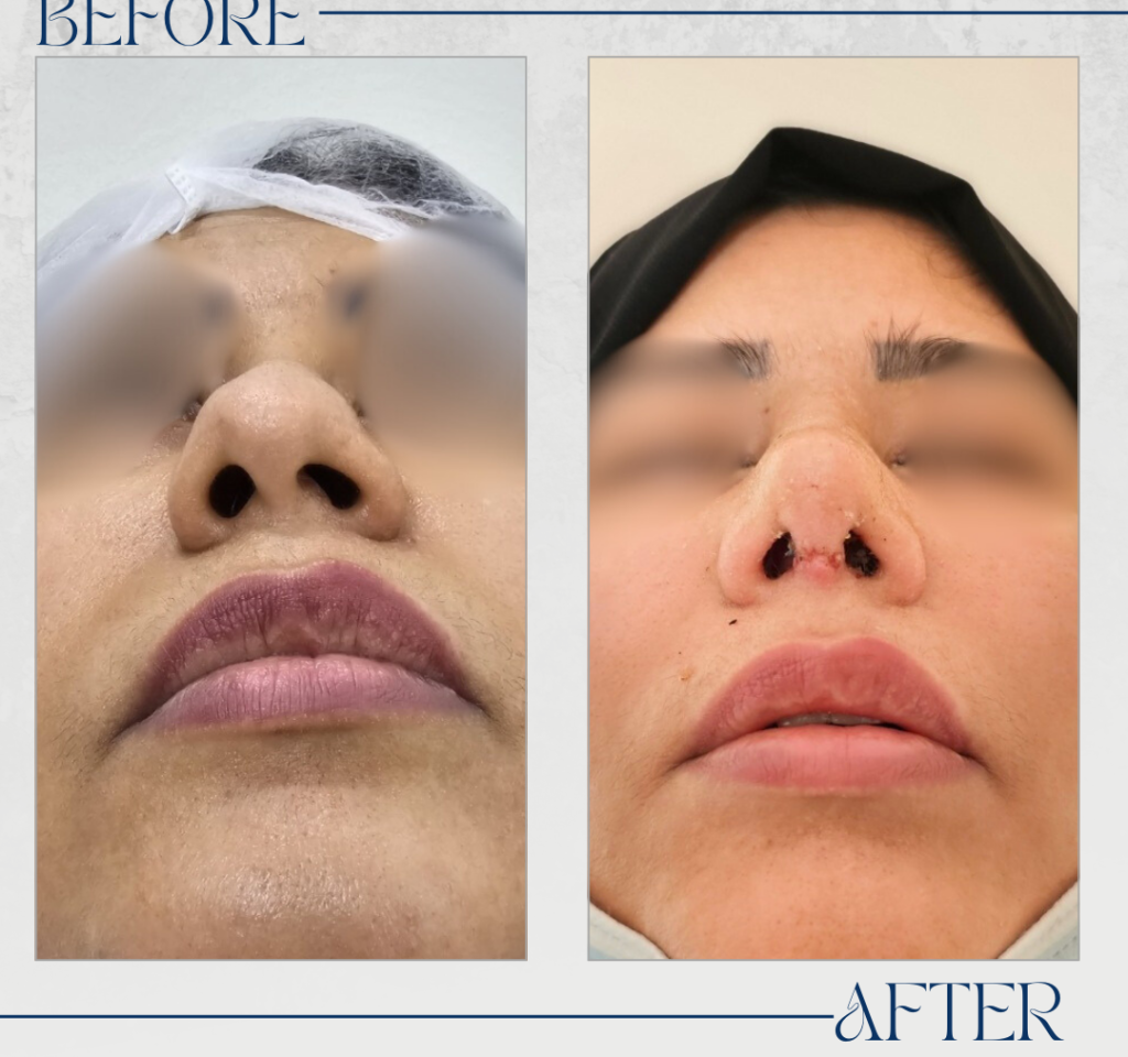 تجميل الأنف
