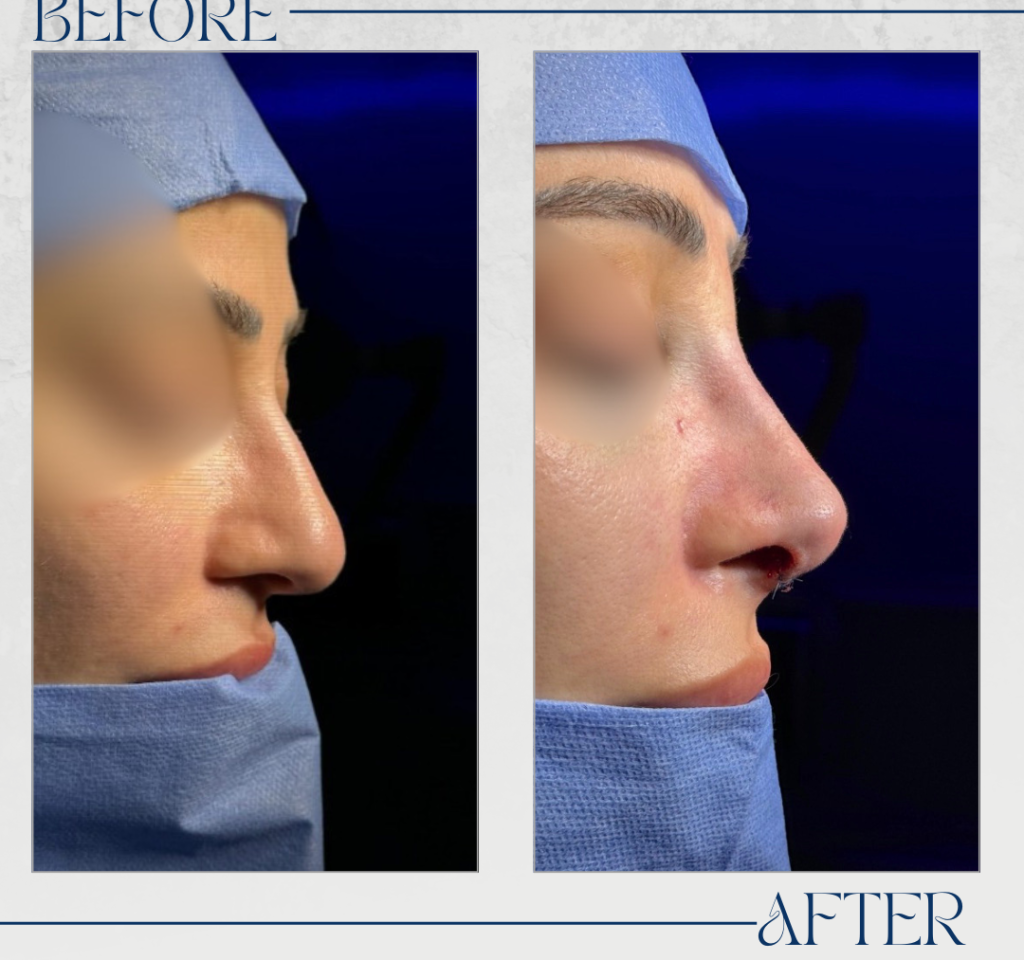 تجميل الأنف
