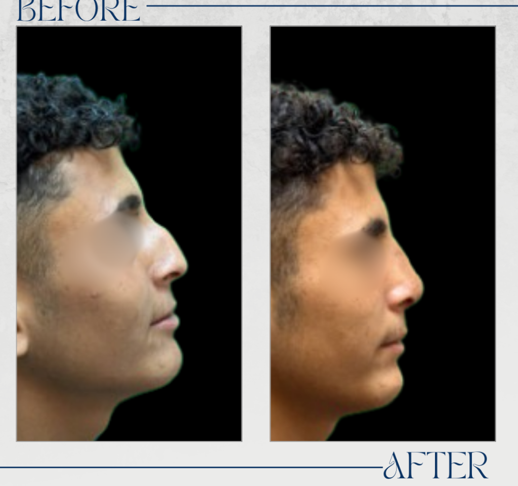 تجميل الأنف
