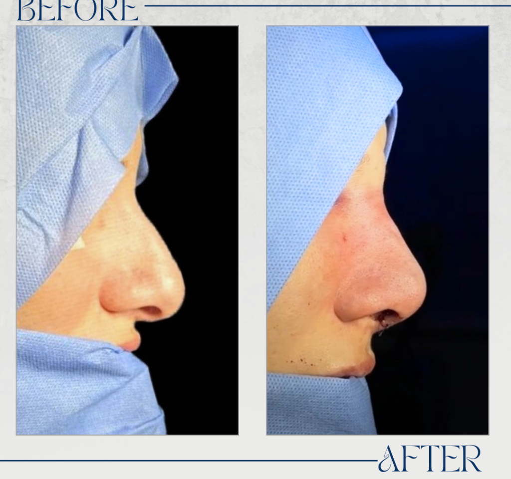 تجميل الأنف