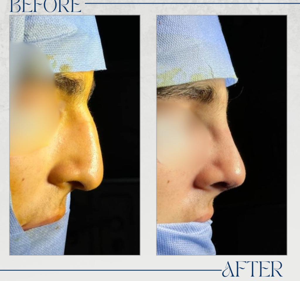 تجميل الأنف