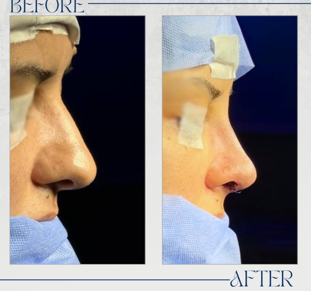 تجميل الأنف