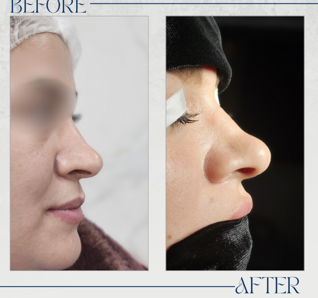 تجميل الأنف